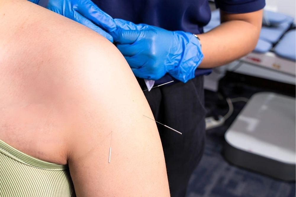 Dry Needling vs. Acupuncture